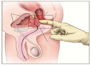 Tỷ lệ bệnh viêm đường tiết niệu ngày càng gia tăng ở mọi đối tượng