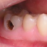 Bệnh sâu răng nên điều trị sao cho nhanh khỏi? đau nhức, khó chịu