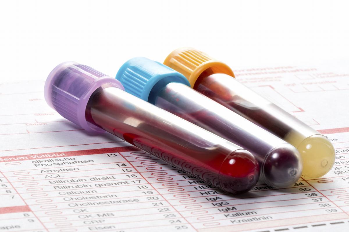 LHD là gì trong xét nghiệm máu?
