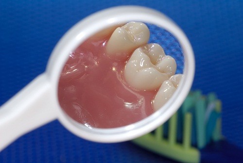 Bệnh tiểu đường khiến nhiều người dễ bị viêm lợi hoặc bệnh tưa miệng.