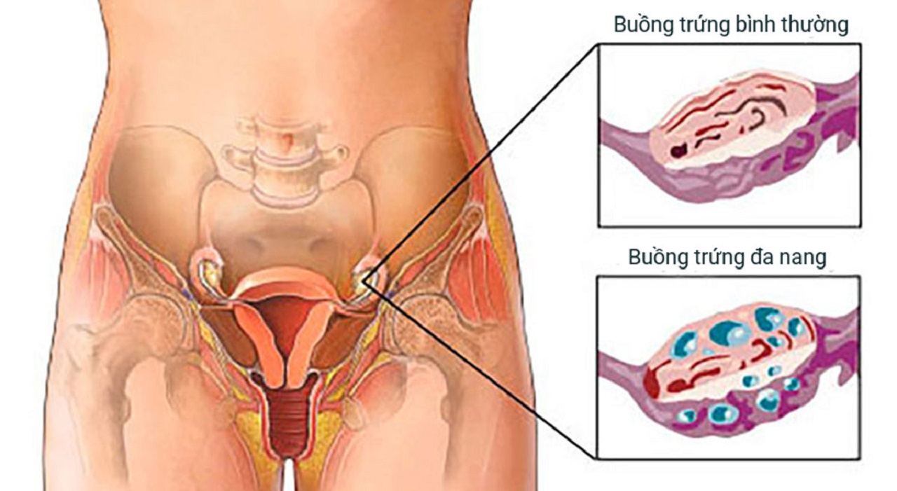 Buồng trứng đa nang là gì?nhiều chị em có thể mắc phải