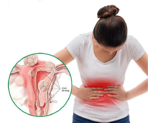 Chị em xuất hiện những cơn đau lan ra đùi và hông đó có thể là triệu chứng của u xơ tử cung