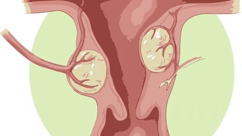 Nhân xơ tử cung là gì? khối u phát triển từ thành tử cung