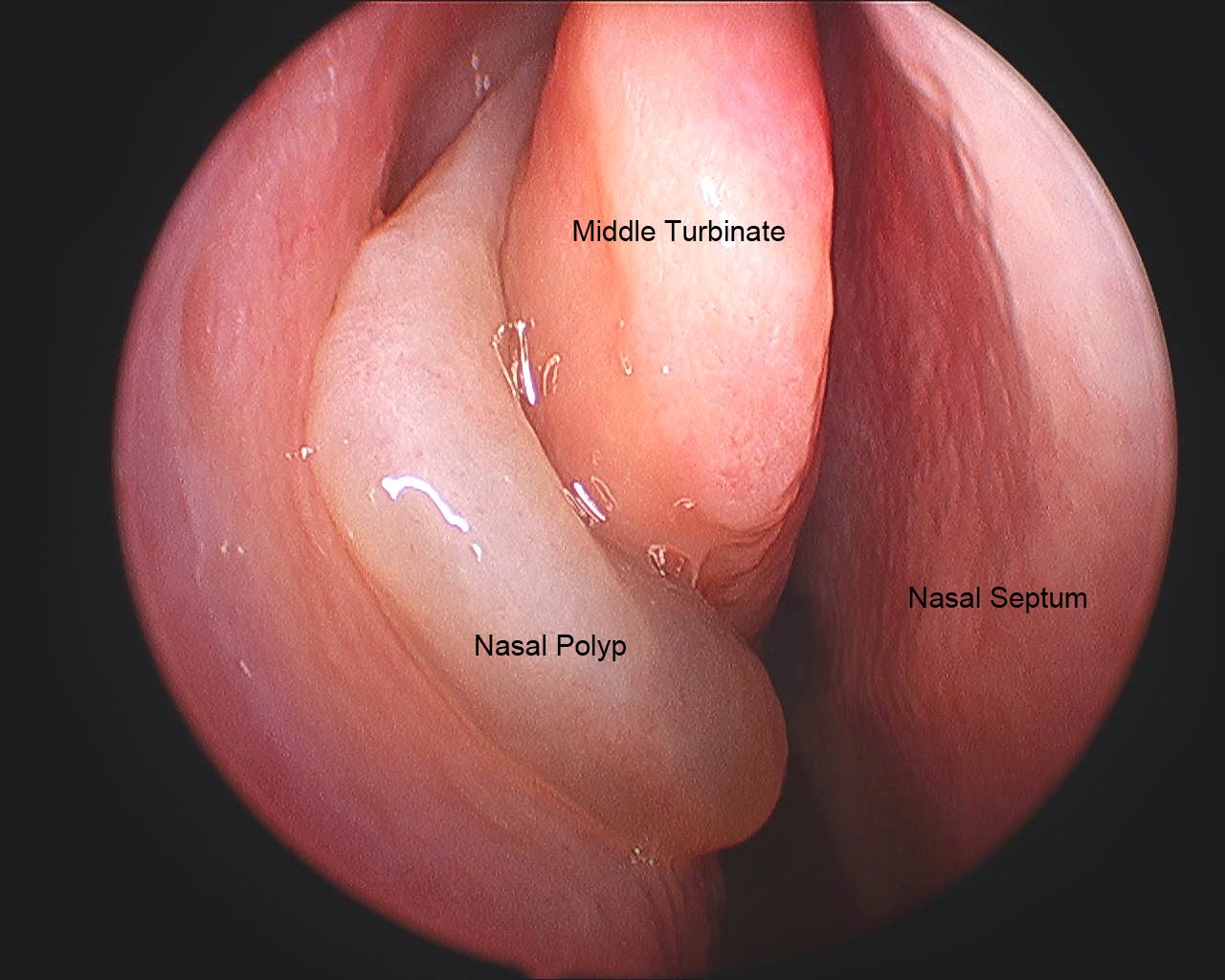 Những thông tin quan trọng về polyp họng là gì bạn nên biết