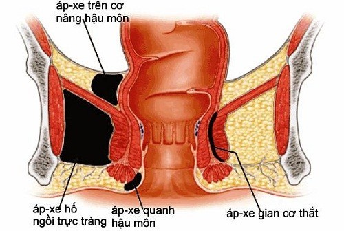 Cách phòng ngừa viêm hậu môn là gì?
