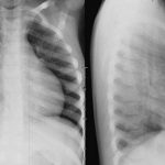 Chụp X-quang tim phổi thẳng phát hiện sớm những bất thường