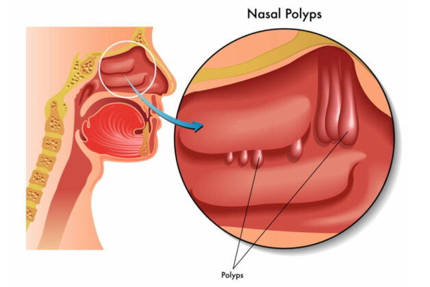 mo polyp mui o dau 1 e1690367083439