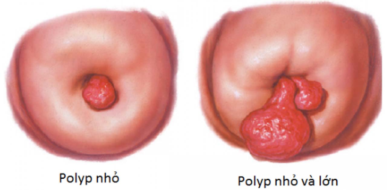 Ít biết về polyp tử cung và ảnh hưởng của chế độ ăn uống? 
