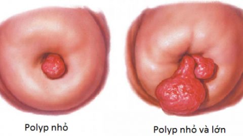 Polyp cổ tử cung là gì? Điều trĩ có dứt điểm được không?