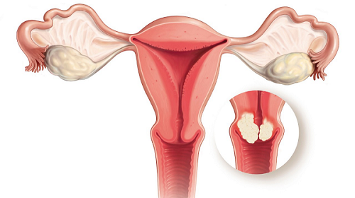 Polyp cổ tử cung là gì?