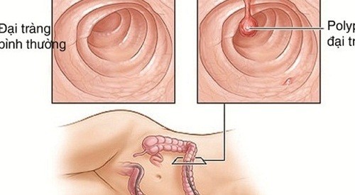 Polyp đại tràng là một khối phát triển bất thường ở bề mặt trong đại tràng