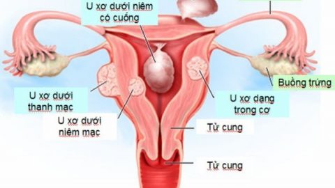 U xơ tử cung – Nguyên nhân, dấu hiệu và cách điều trị