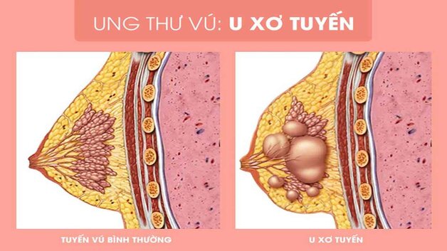 4. Các nghiên cứu liên quan đến chế độ ăn và u xơ tuyến vú