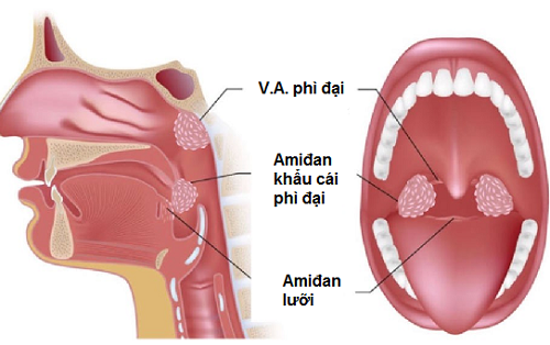 Cách điều trị viêm VA quá phát là gì?

