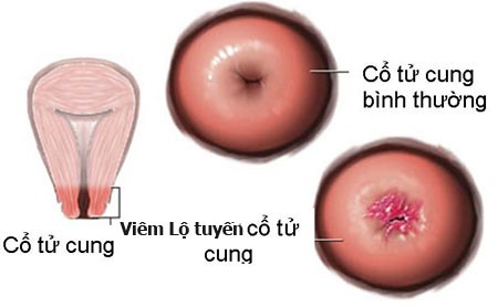 Viêm lộ tuyến cổ tử cung.