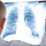 Cách phòng lao phổi tái phát ức đề kháng suy yếu