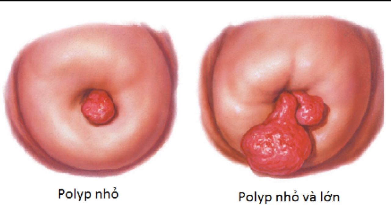 Quá trình hình thành và phát triển của polyp tử cung ra sao?
