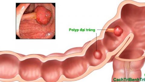 Điều trị polyp đại tràng