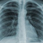 Chụp X-quang có ảnh hưởng đến sức khỏe không?