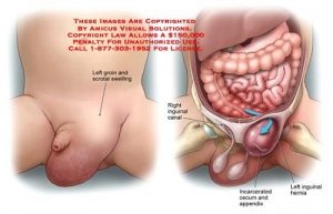 Thoát vị bẹn gây biến chứng vô sinh, biểu hiện bởi khối phồng ở bìu (nam giới), môi lớn (nữ giới).