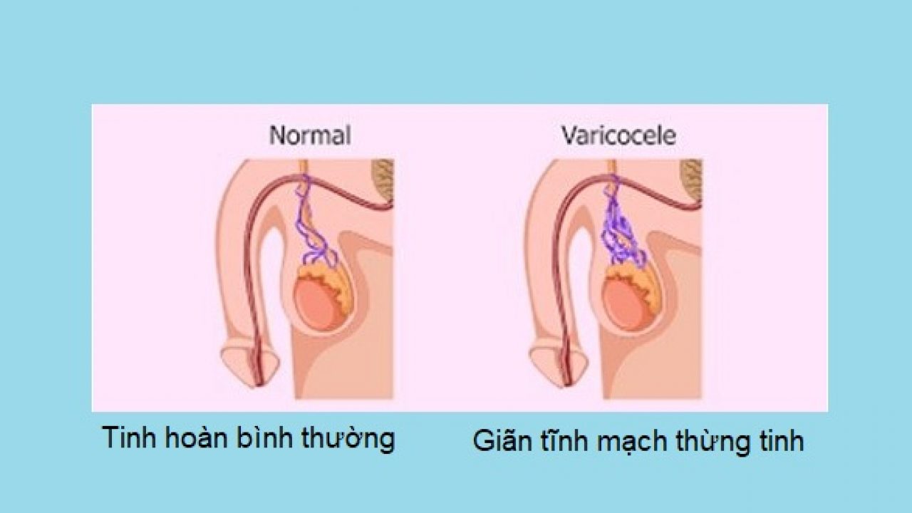 Lý do gây ra giãn tĩnh mạch ở trẻ em là gì?
