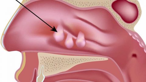 Tìm hiểu về phẫu thuật cắt polyp mũi