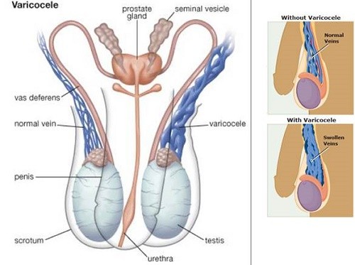 Có cách nào phòng ngừa giãn tĩnh mạch thừng tinh không?
