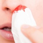 Nguyên nhân gây chảy máu mũi ở người lớn