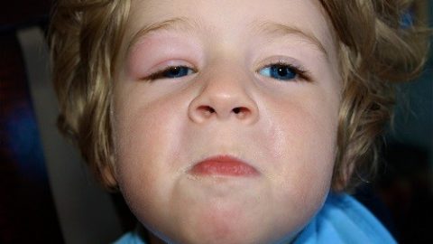Nguyên nhân nào dẫn dến tình trạng sưng mí mắt ở trẻ?