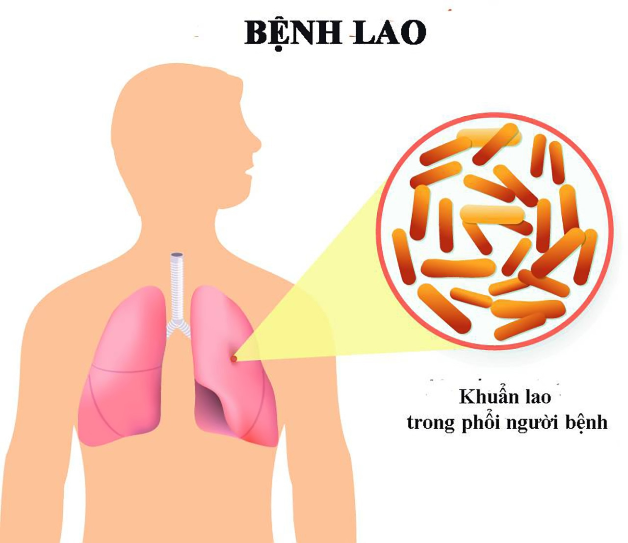 Làm thế nào để phòng ngừa bệnh lao phổi kháng thuốc?
