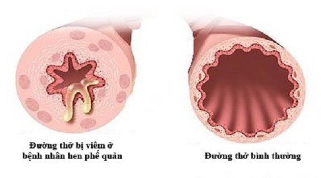 Triệu chứng và cách điều trị hen suyễn dị ứng hiệu quả