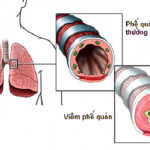 Bệnh thường gặp ở phổi khi chuyển mùa