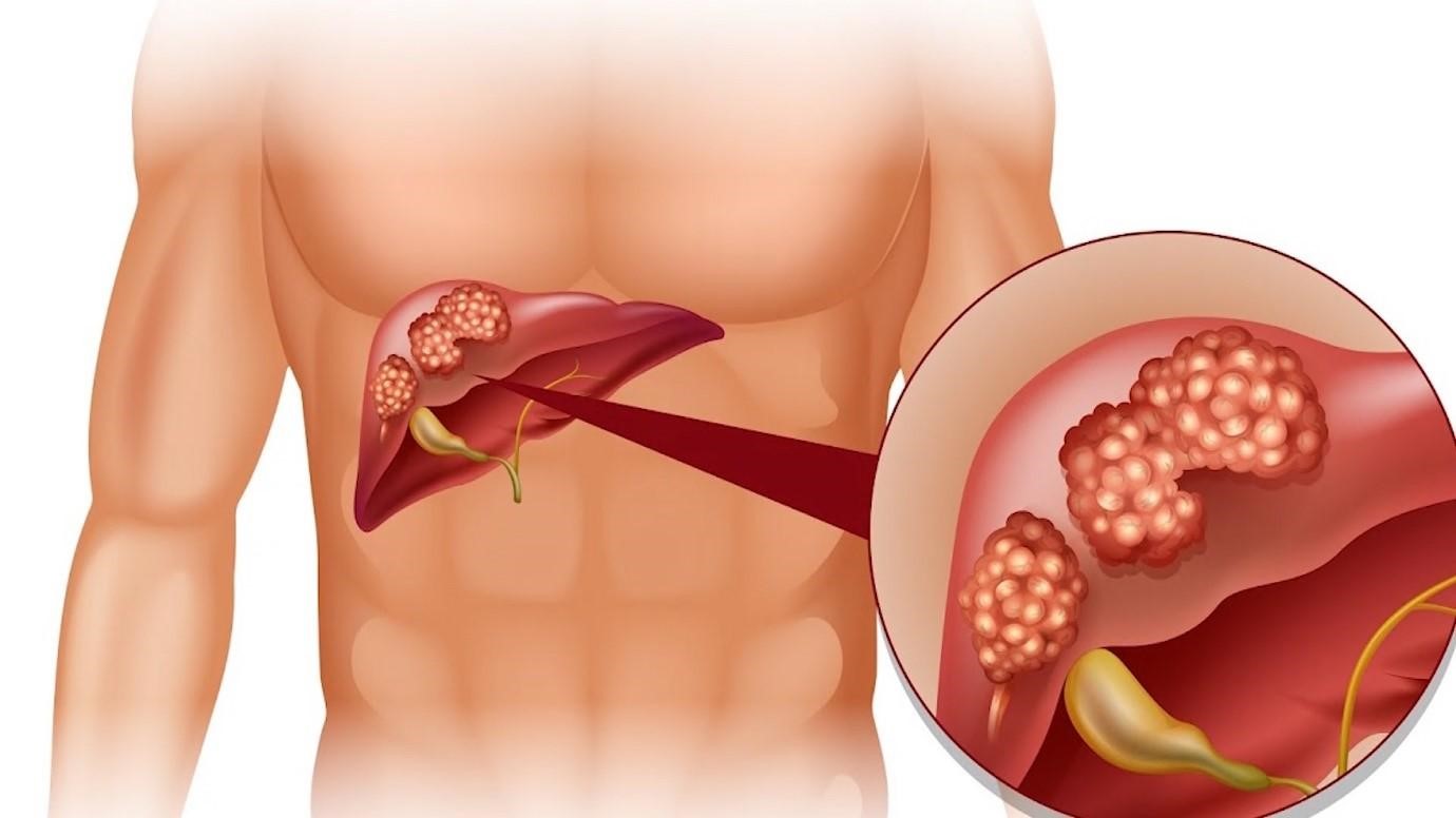 Bệnh lá lách được gây ra bởi những nguyên nhân gì?