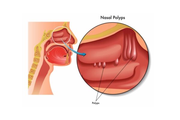 mo polyp mui bao nhieu tien 6