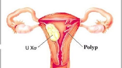 Polyp buồng tử cung và những điều cần biết