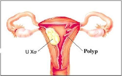 Câu trả lời polyp buồng tử cung là gì đầy đủ và chi tiết