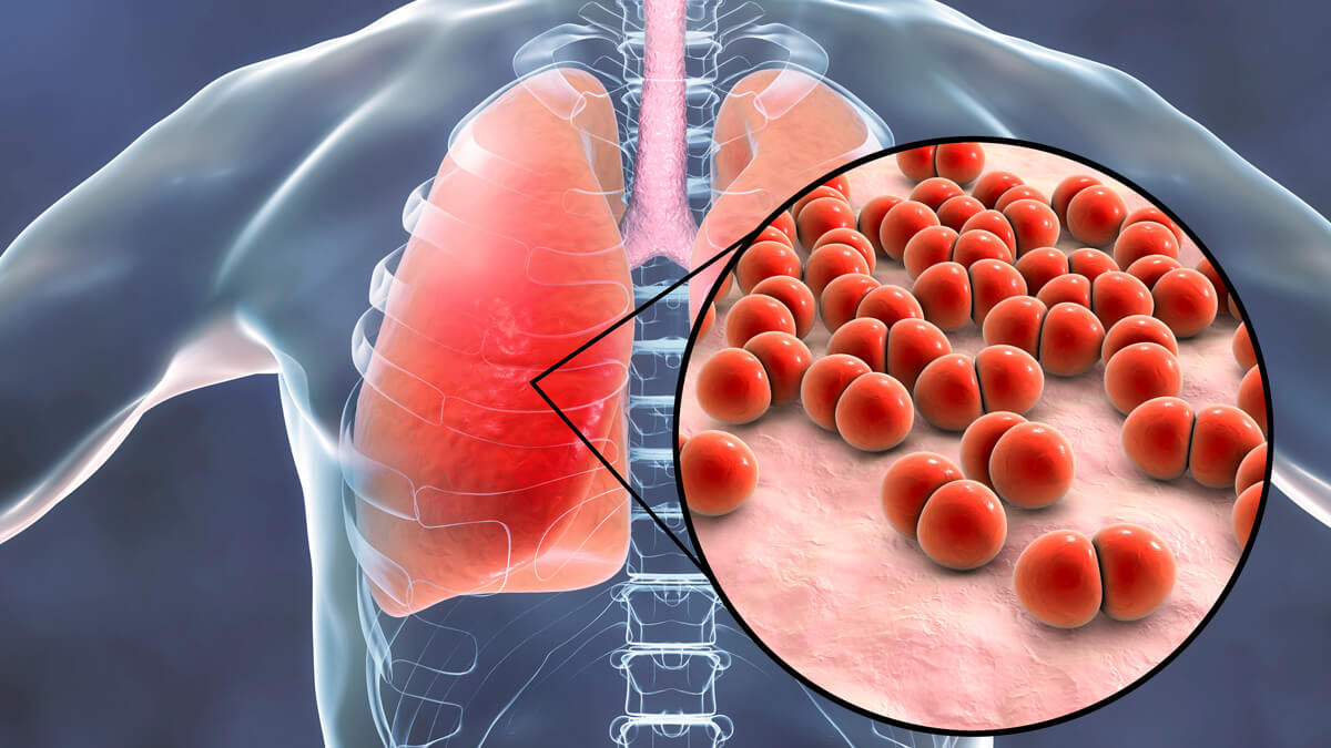 Triệu chứng lâm sàng của viêm phổi là gì?
