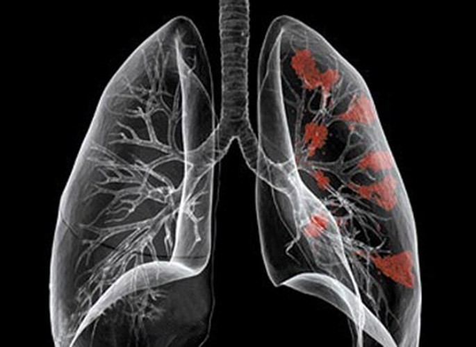 Tại sao chi phí chụp CT phổi lại khác nhau tùy từng nơi, từng trường hợp?
