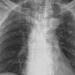Chụp X quang phổi bao nhiêu tiền? Cần lưu ý những gì?