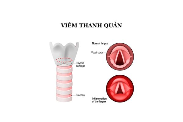 dieu tri viem thanh quan