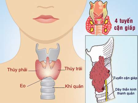 U tuyến giáp nguy hiểm cần được phát hiện sớm và điều trị hiệu quả