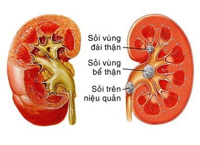 Sỏi niệu quản cần được phát hiện sớm và điều trị hiệu quả