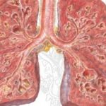 Nguyên nhân gây xơ phổi gây sẹo tiến triển của mô phổi