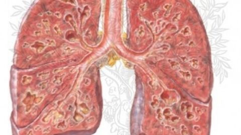 Nguyên nhân gây xơ phổi gây sẹo tiến triển của mô phổi