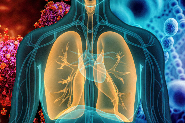 Viêm phổi là tình trạng viêm nhiễm nhu mô phổi