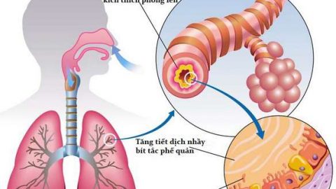 6 bệnh viêm phổi và viêm phế quản thường gặp ở trẻ