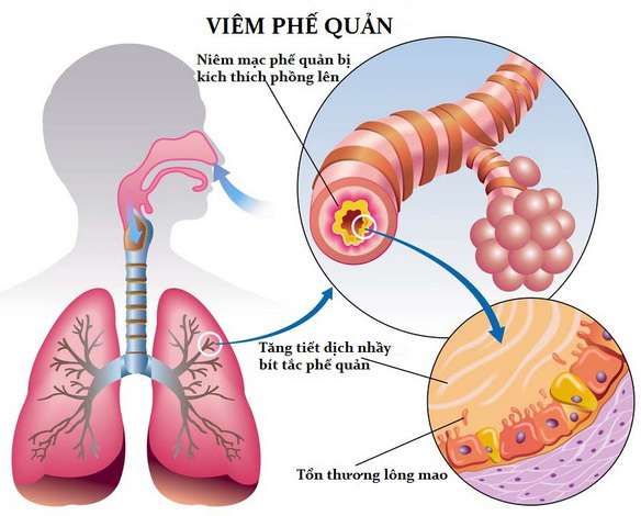 Làm thế nào để giảm triệu chứng của viêm phế quản dạng hen?
