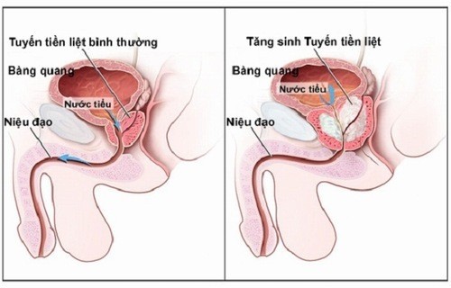 Giải pháp hiệu quả điều trị vôi hóa tuyến tiền liệt 