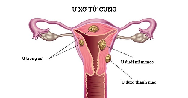 U xơ tử cung thường xuất hiện ở phụ nữ trong độ tuổi sinh đẻ