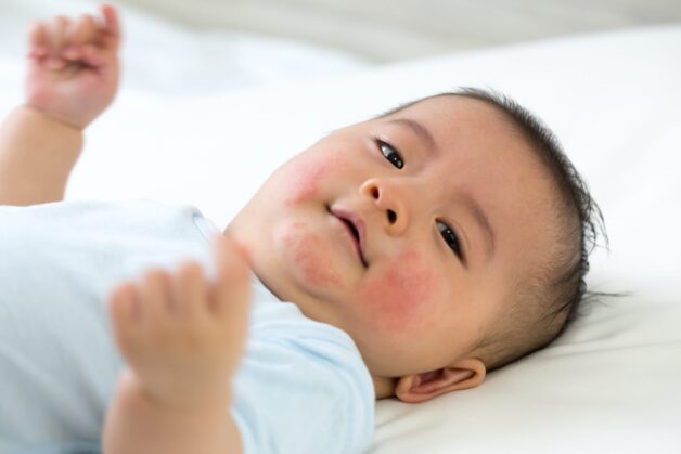 Chàm sữa, còn được gọi là lác sữa, thường xuất hiện ở trẻ từ 2 tháng tuổi với tỷ lệ 20/100